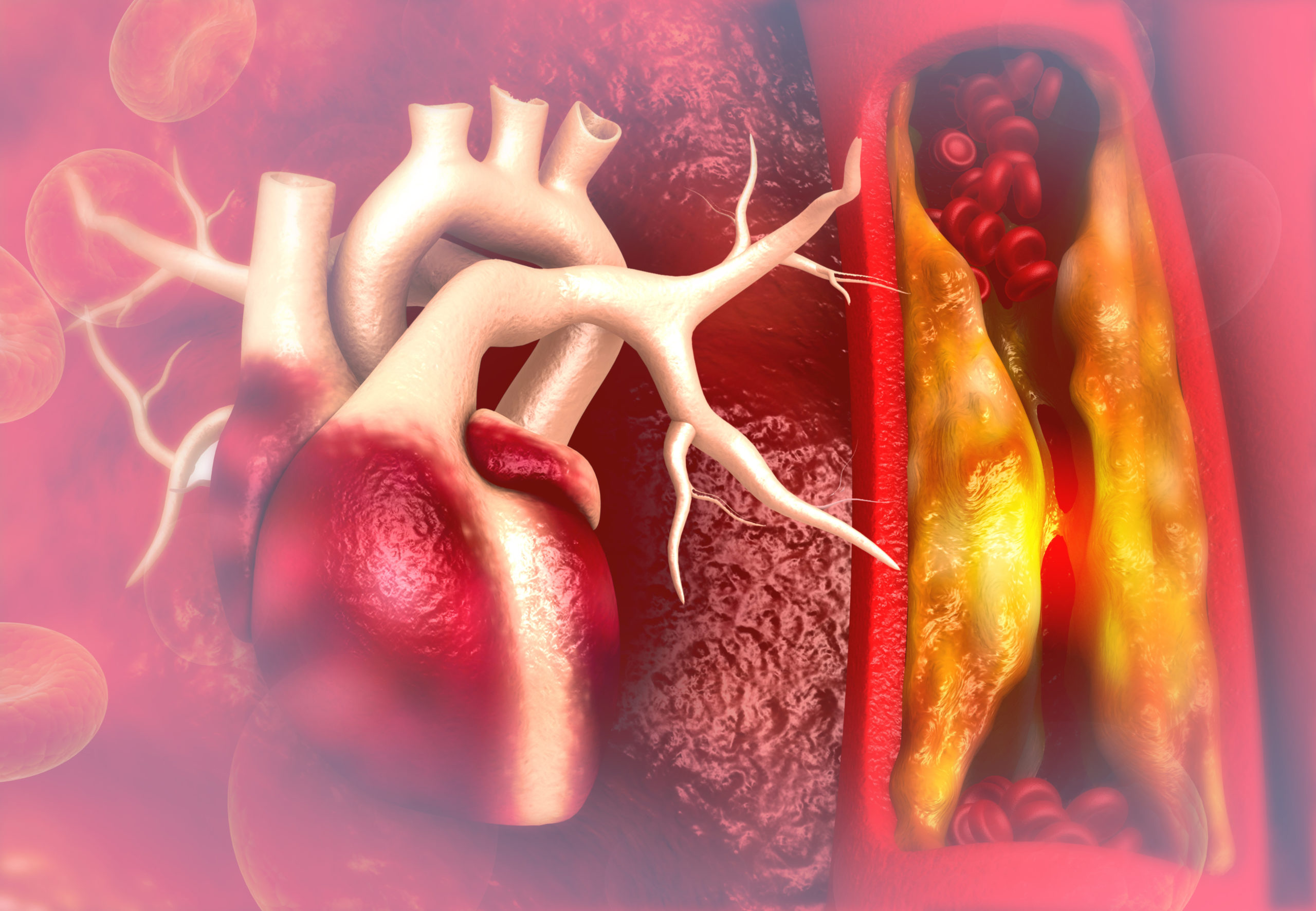 Herzinfarkt unter 50? Blutfette beachten und Lipoprotein(a)-Wert bestimmen!